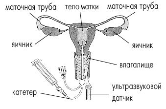 Клиника НЕО-МЕД. Ультразвуковая гистеросальпингоскопия